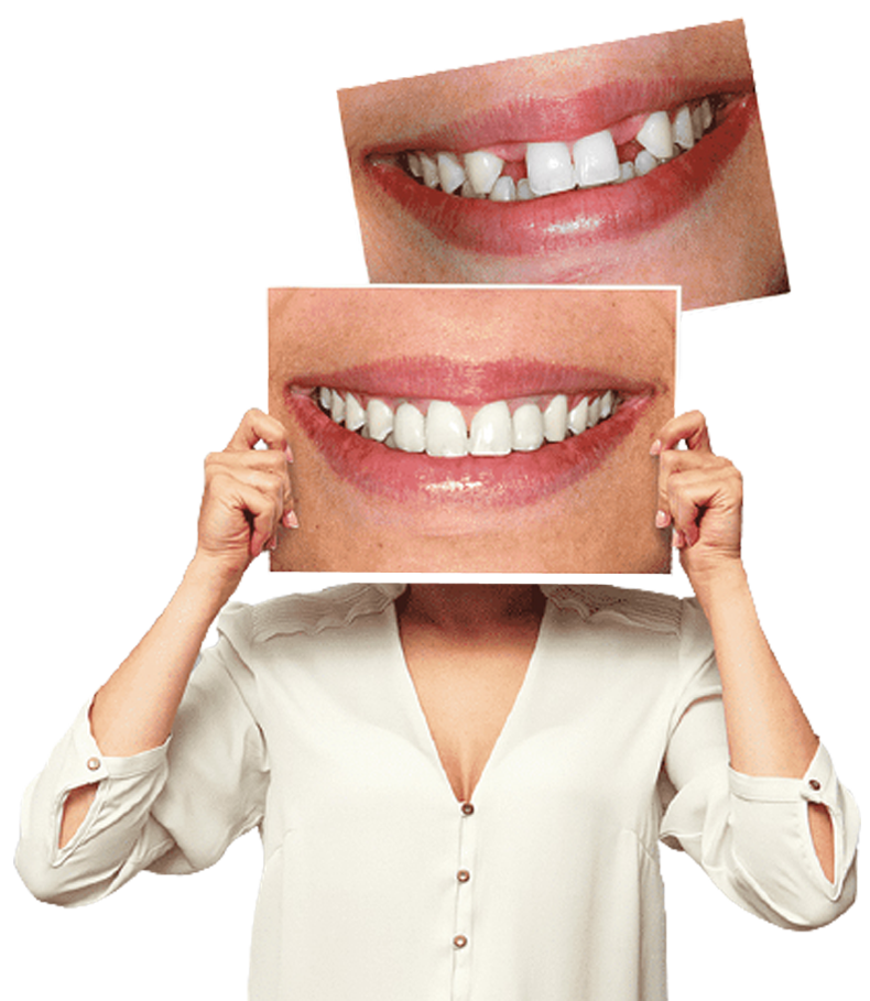 Creative before and after comparison showing smile improvement after cosmetic dental treatment for whiter, more aligned teeth.