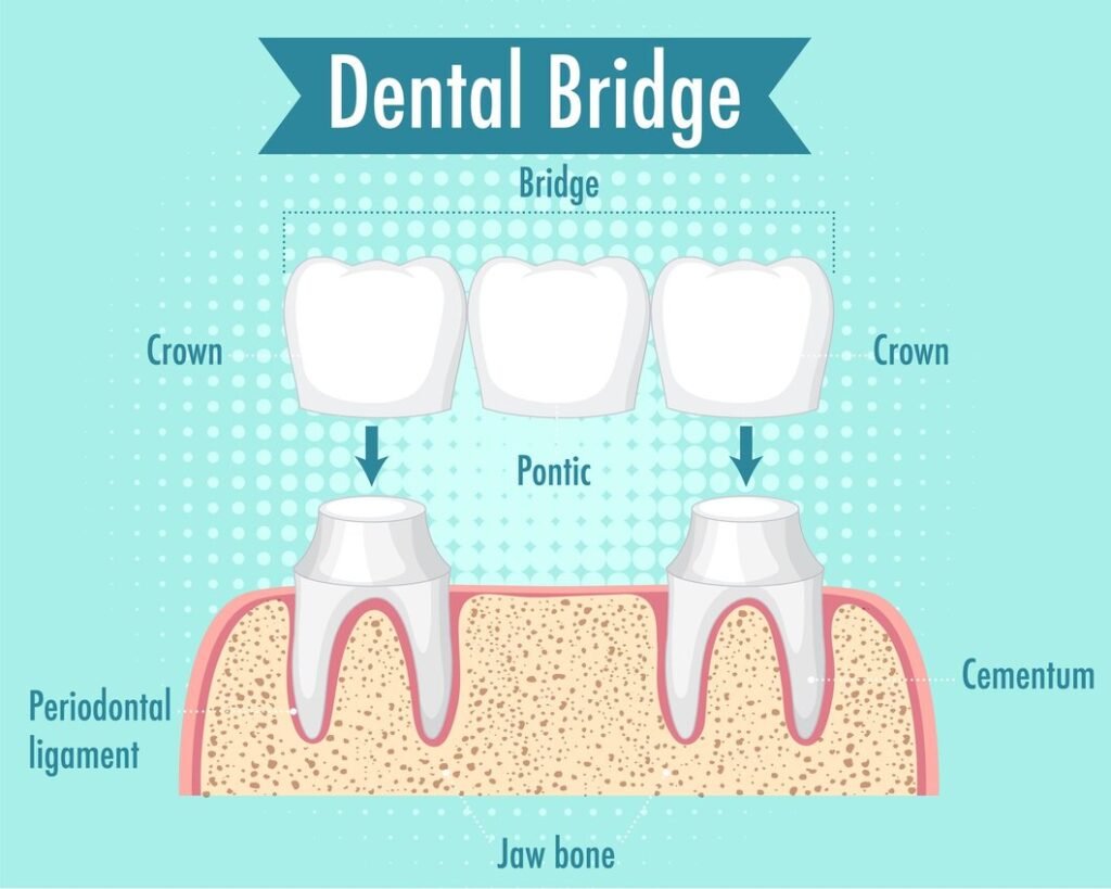 Dental bridge procedure showing crown and pontic placement