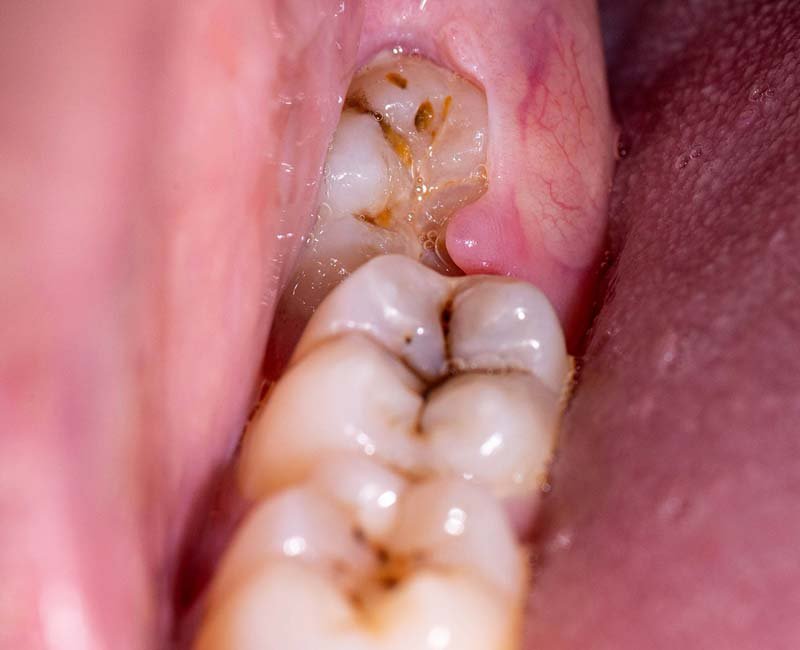Impacted wisdom tooth with decay and gum inflammation