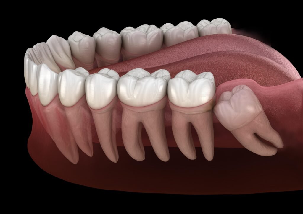 Impacted wisdom tooth causing pressure and pain in lower jaw