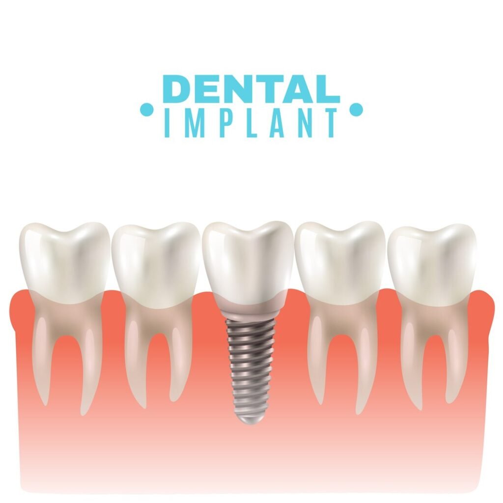 Dental implant placed in jawbone showing artificial tooth replacing missing tooth