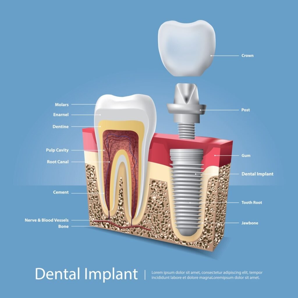 Dental implant structure showing crown, implant post, jawbone, and tooth root anatomy