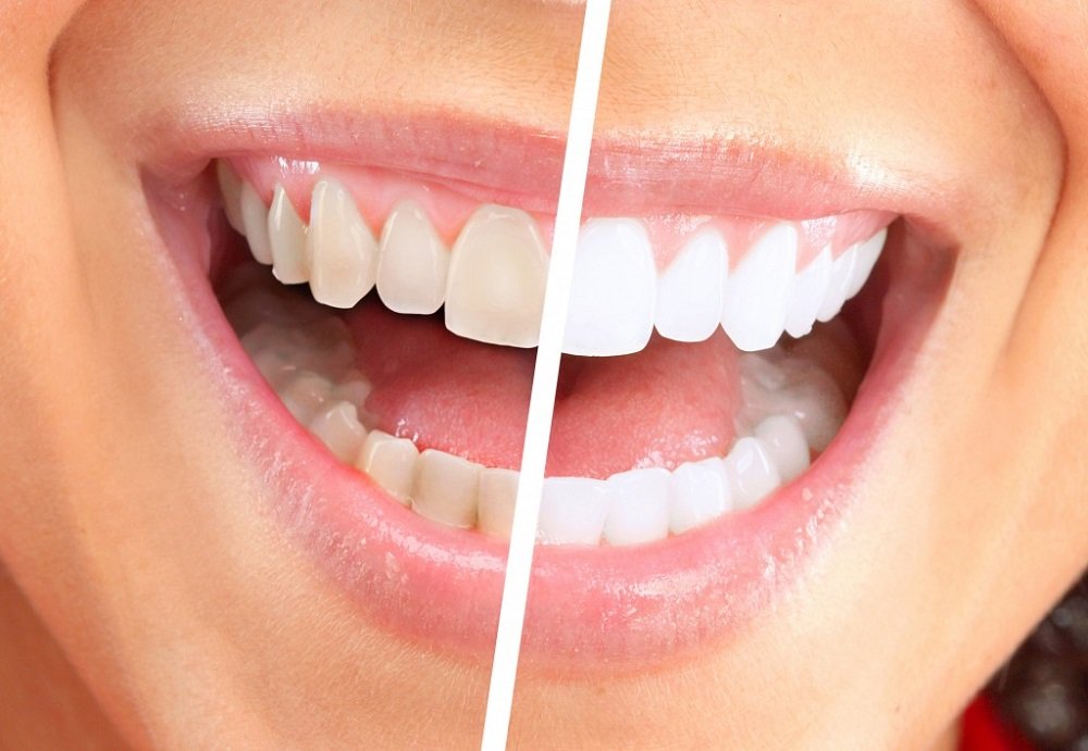 Professional teeth cleaning showing before and after results with brighter, stain-free teeth