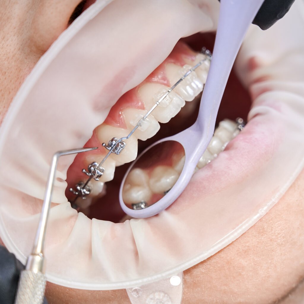 Close-up view of dental braces being adjusted during orthodontic treatment