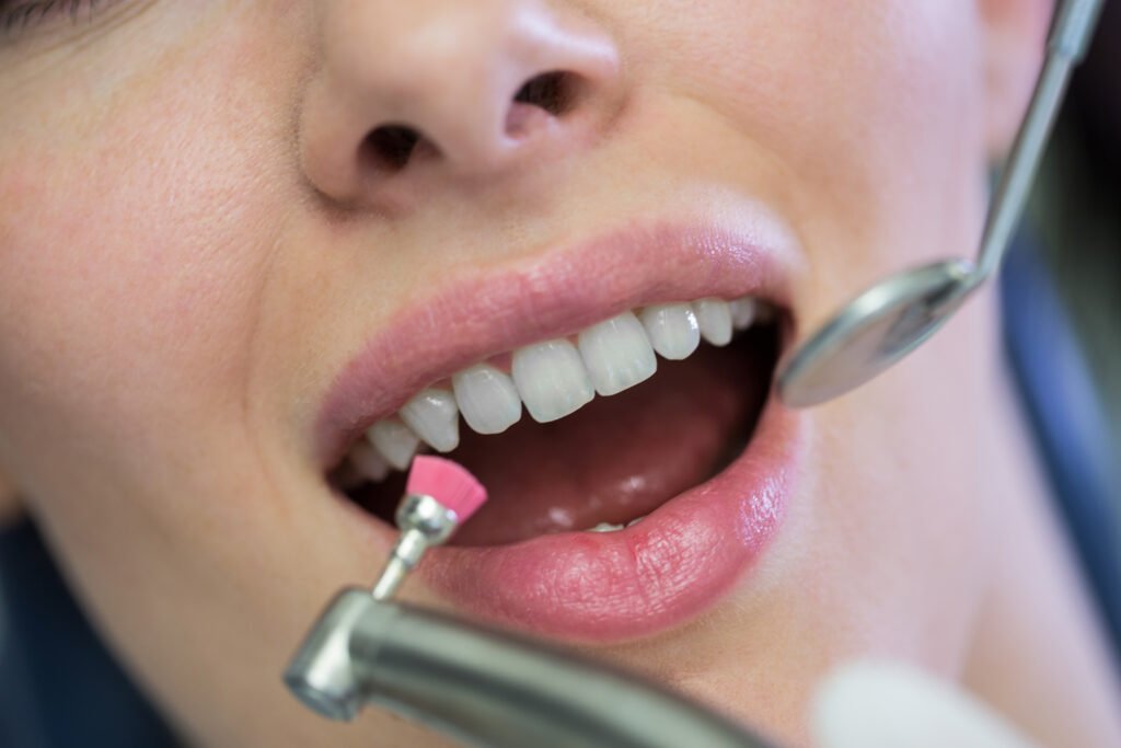 Dental polishing procedure being performed to clean and smooth teeth surface