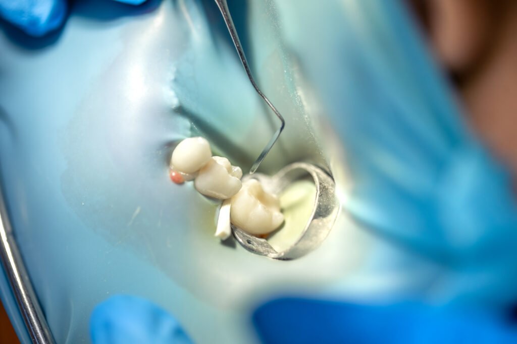 Dental treatment being performed with rubber dam isolation for precise tooth care