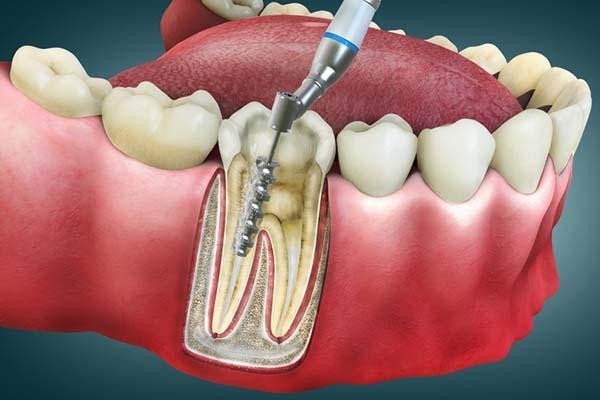 Painless root canal treatment removing infected tooth pulp using advanced dental tools