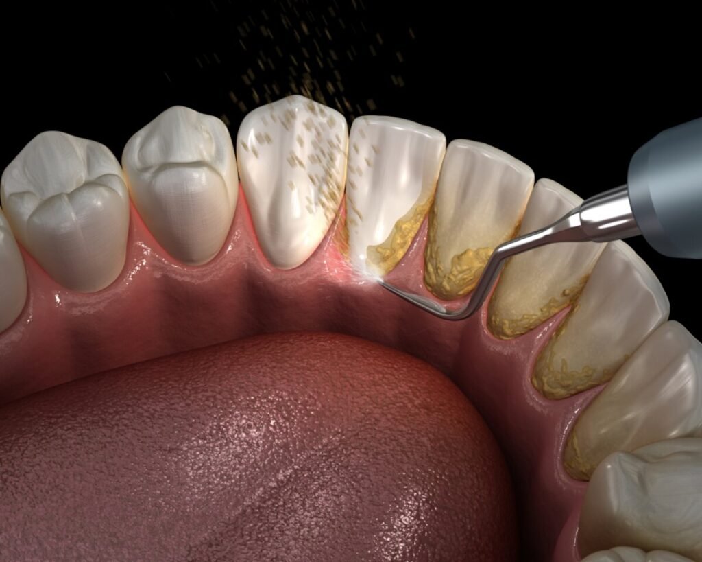 Dental scaling procedure removing plaque and tartar from teeth for improved oral hygiene